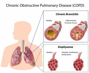 COPD